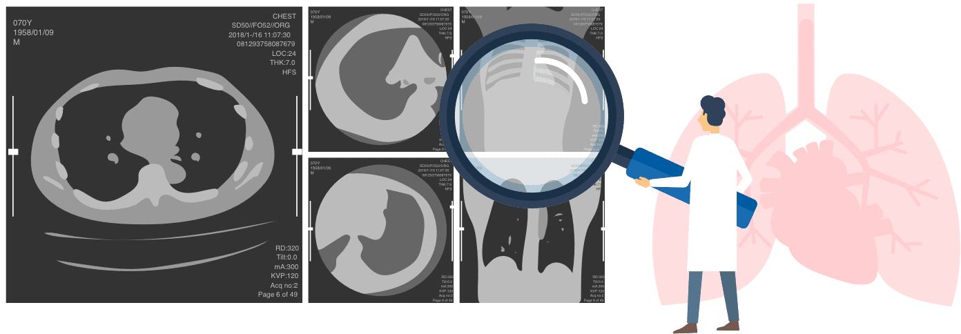 胸部CT肺ドックのイメージ