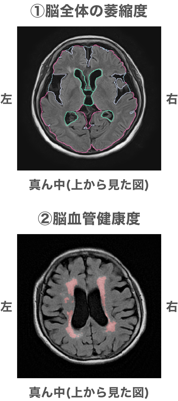 ①脳全体の萎縮度、②脳血管健康度